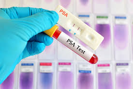 PROSTATE CANCER SCREENING IN UGANDAN MEN